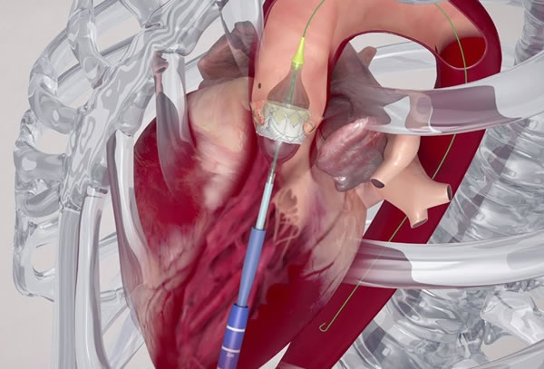 Implante Transcateter de Válvula (TAVI)