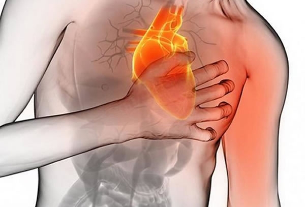 Infarto Agudo do Miocárdio